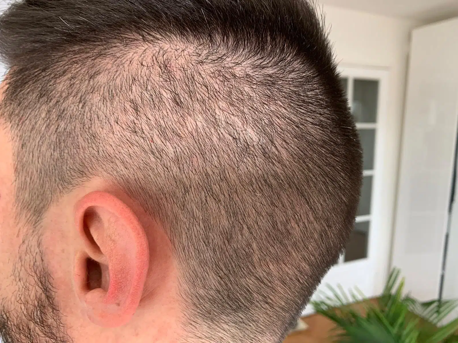 Se gratter après une greffe de cheveux