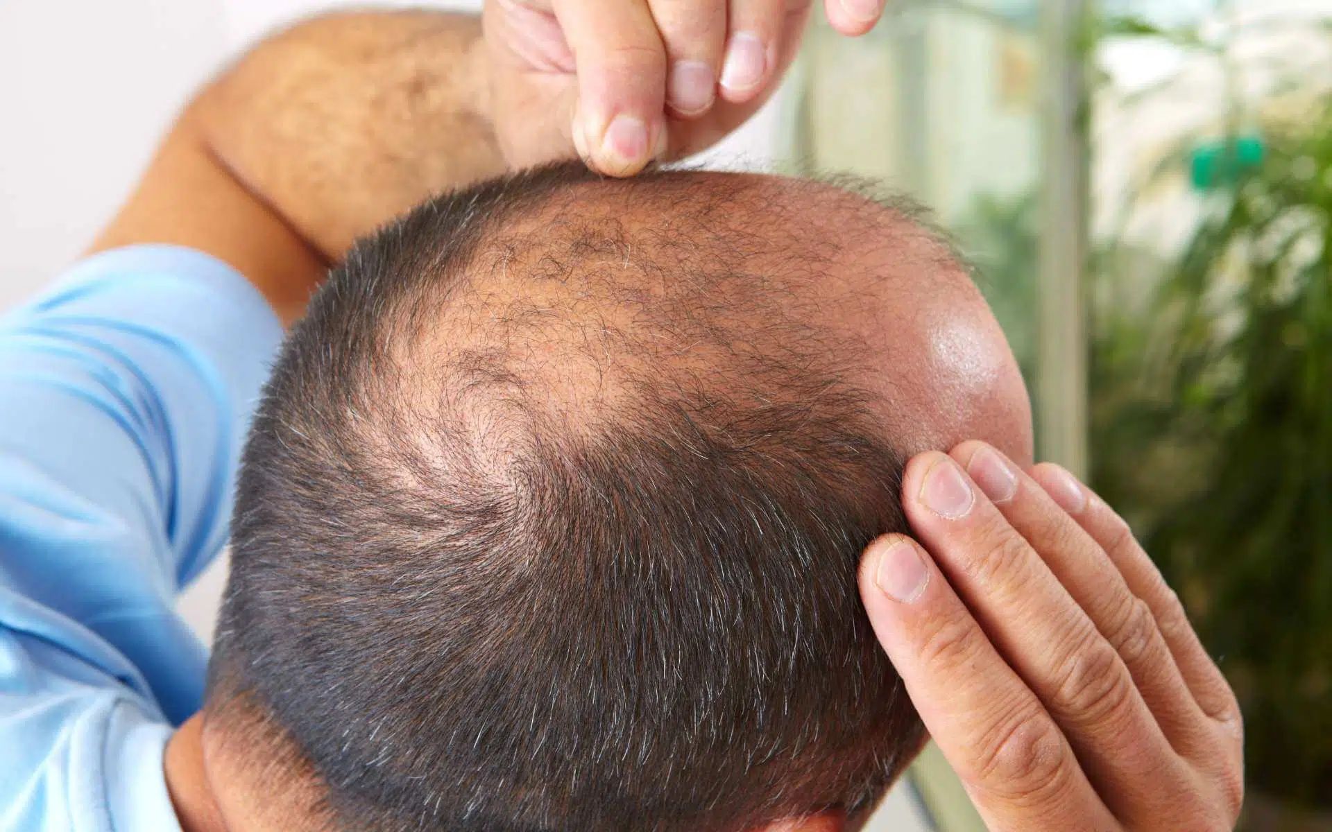 Se gratter après une greffe de cheveux